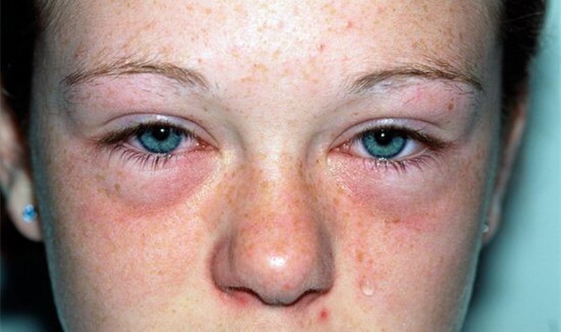 симптомы аллергического ринита и конъюнктивита