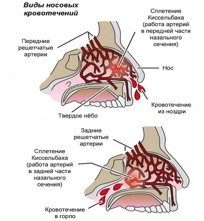Виды носовых кровотечений