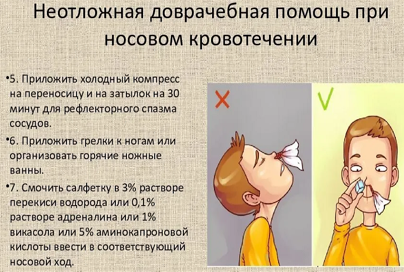 Доврачебная помощь при носовом кровотечении