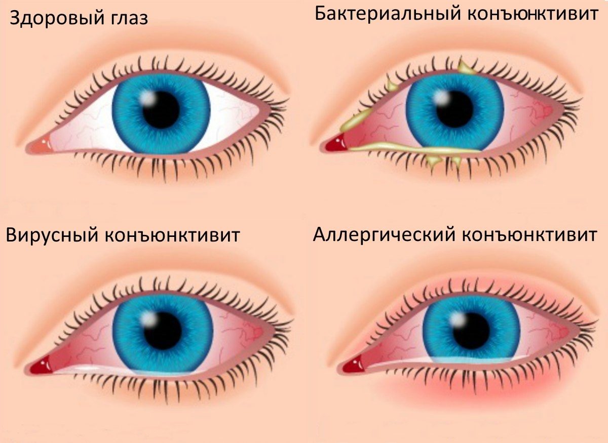 Виды-конъюнктивита