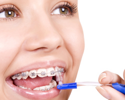 Как да си миете зъбите със брекети с възрастни и деца на зъбната четка: Съвети за зъболекар, схема за движение на четката за зъби, избор на четка за зъби и паста за зъби