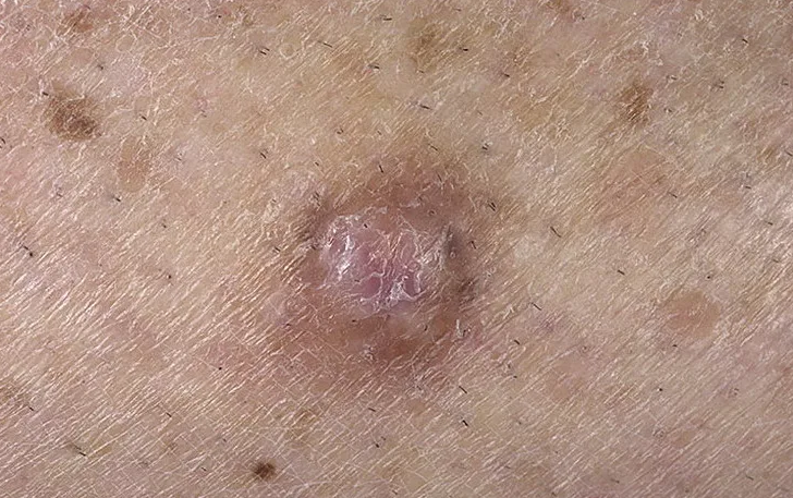 Sífilis: la causa del acné en el pubis
