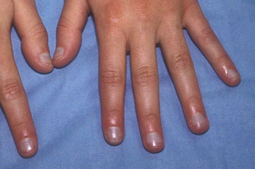 Синий цвет ногтей,свидетельствует о тяжелом сердечно-сосудистом заболевании
