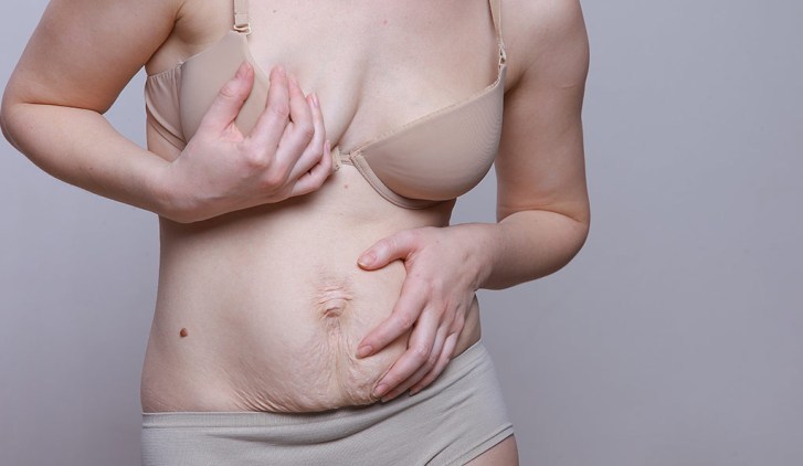 Desventaja en la apariencia de una mujer No. 5, que asusta a los hombres: piel caída del abdomen