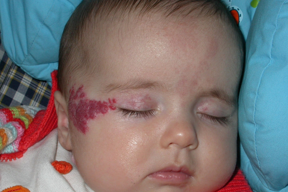 ребенок с гемангиомой на лице