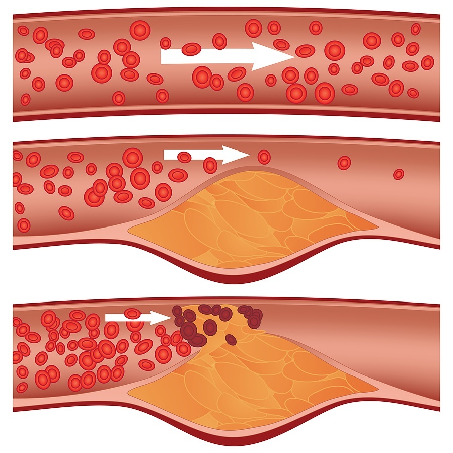 Patología de los vasos sanguíneos