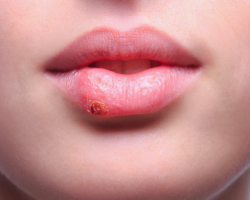Герпес — заразен или нет? Что нельзя делать при вирусе герпеса на губах: заразен или нет при поцелуе?