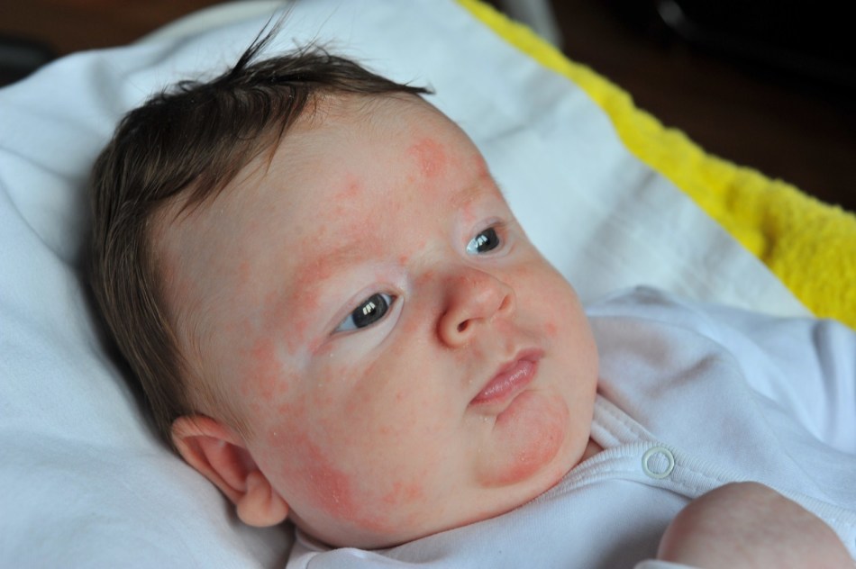 Аллергия-у-новорожденного-лечение-фенистилом