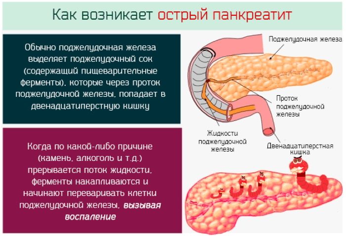 Как возникает панкреатит