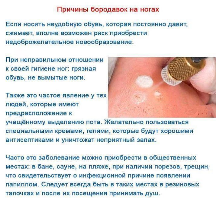 Причины появления бородавок на ногах