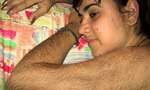 Повышенная волосатость на руках и лице девушки