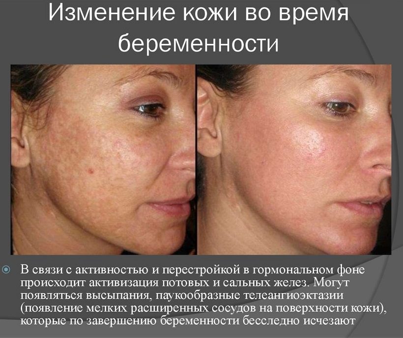 Пигментация во время беременности