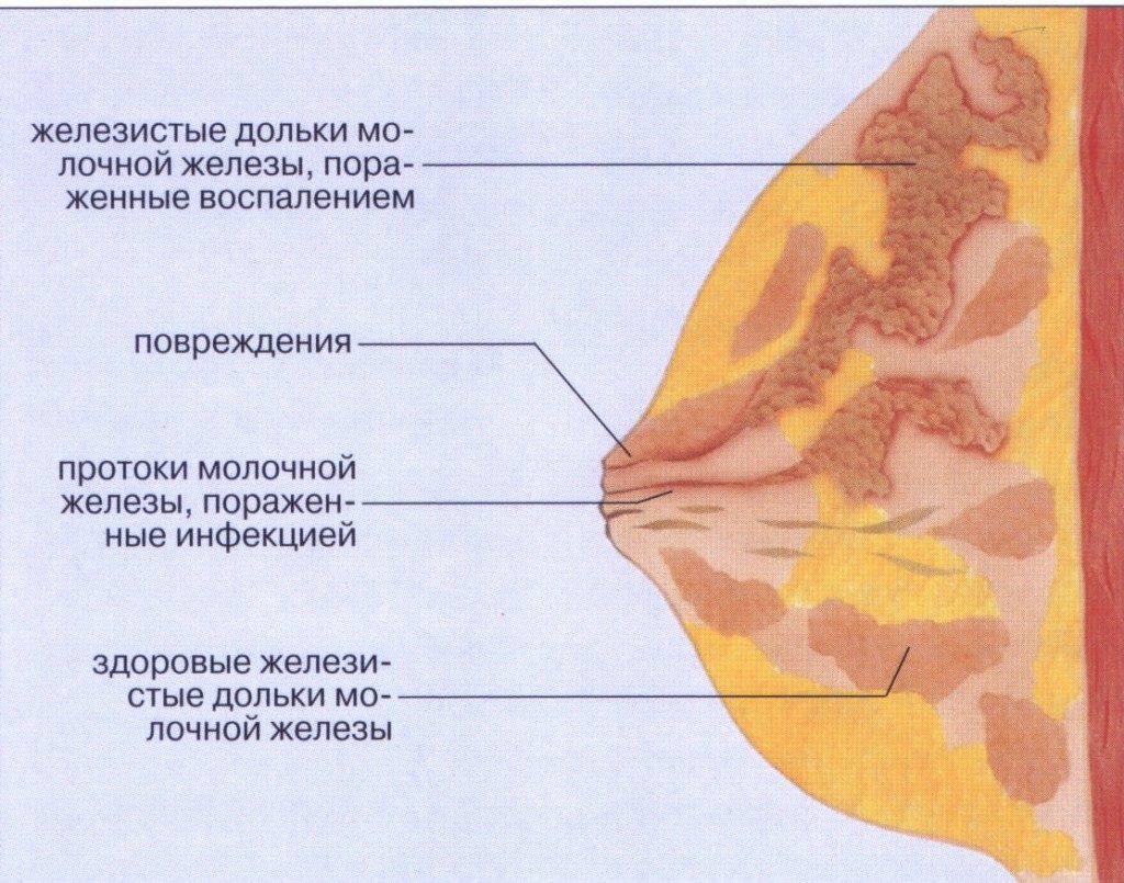 Лактостаз