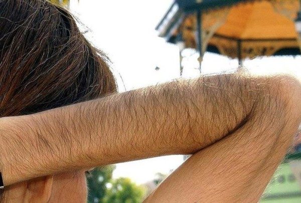 Гипертрихоз у женщины