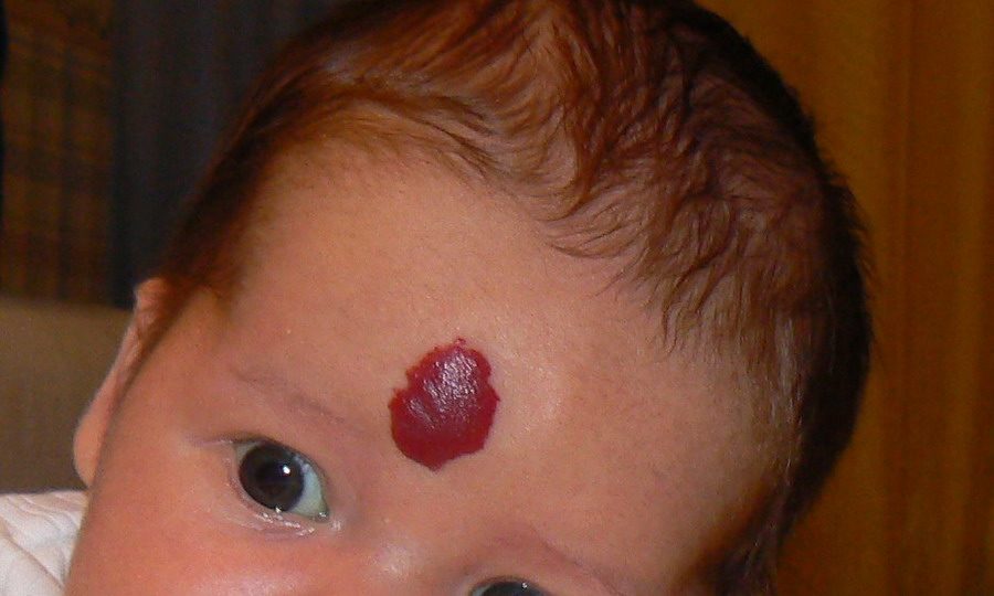 Некоторые гемангиомы выглядят ужасно и причиняют малышу немало страданий и переживаний