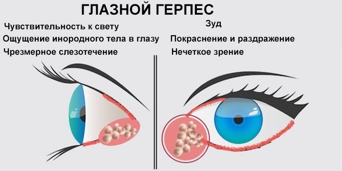 Глазной герпес