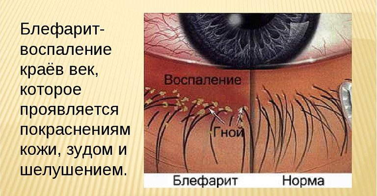Блефарит