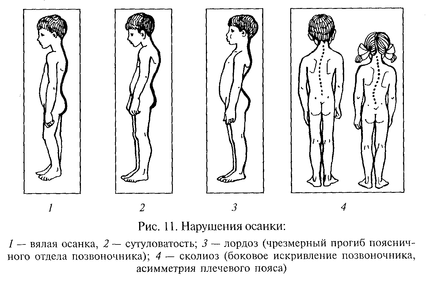Виды нарушения осанки у детей