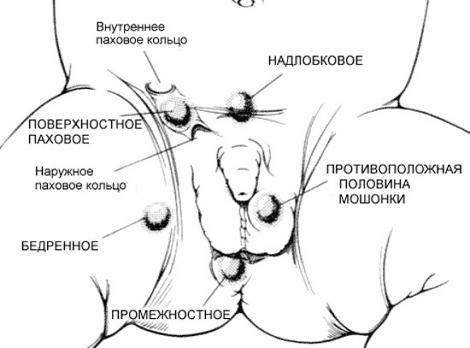 Крипторхизм и бесплодие