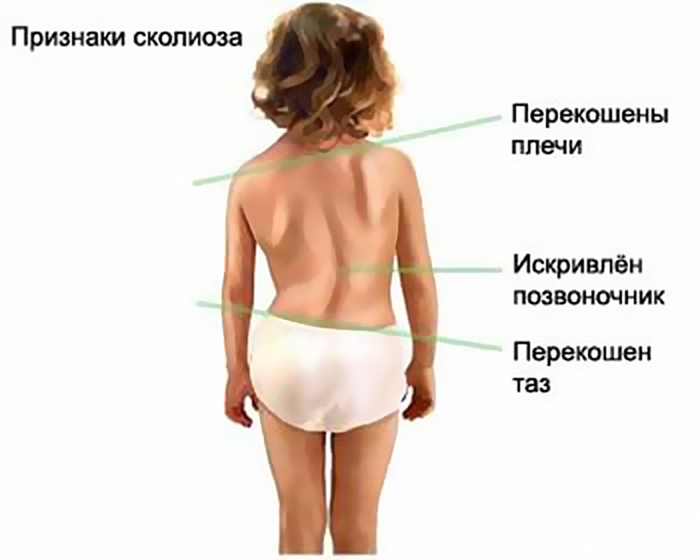 Сколиоз у детей