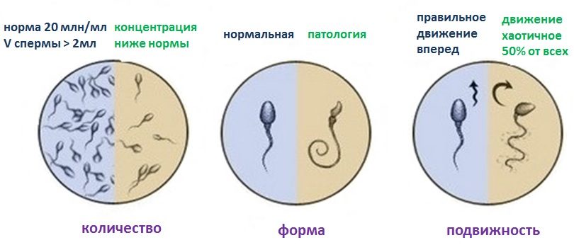 Степени олигоспермии