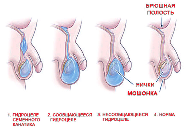 Грыжа яичка у новорожденного