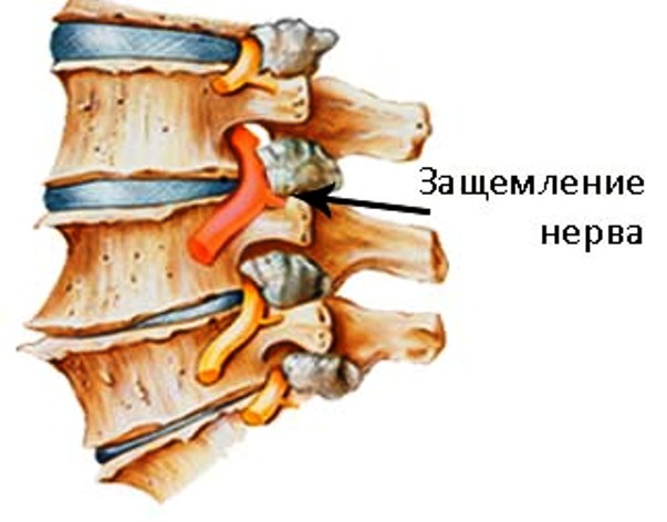 Защемление нерва
