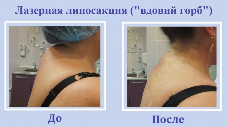 Лазерный липолиз