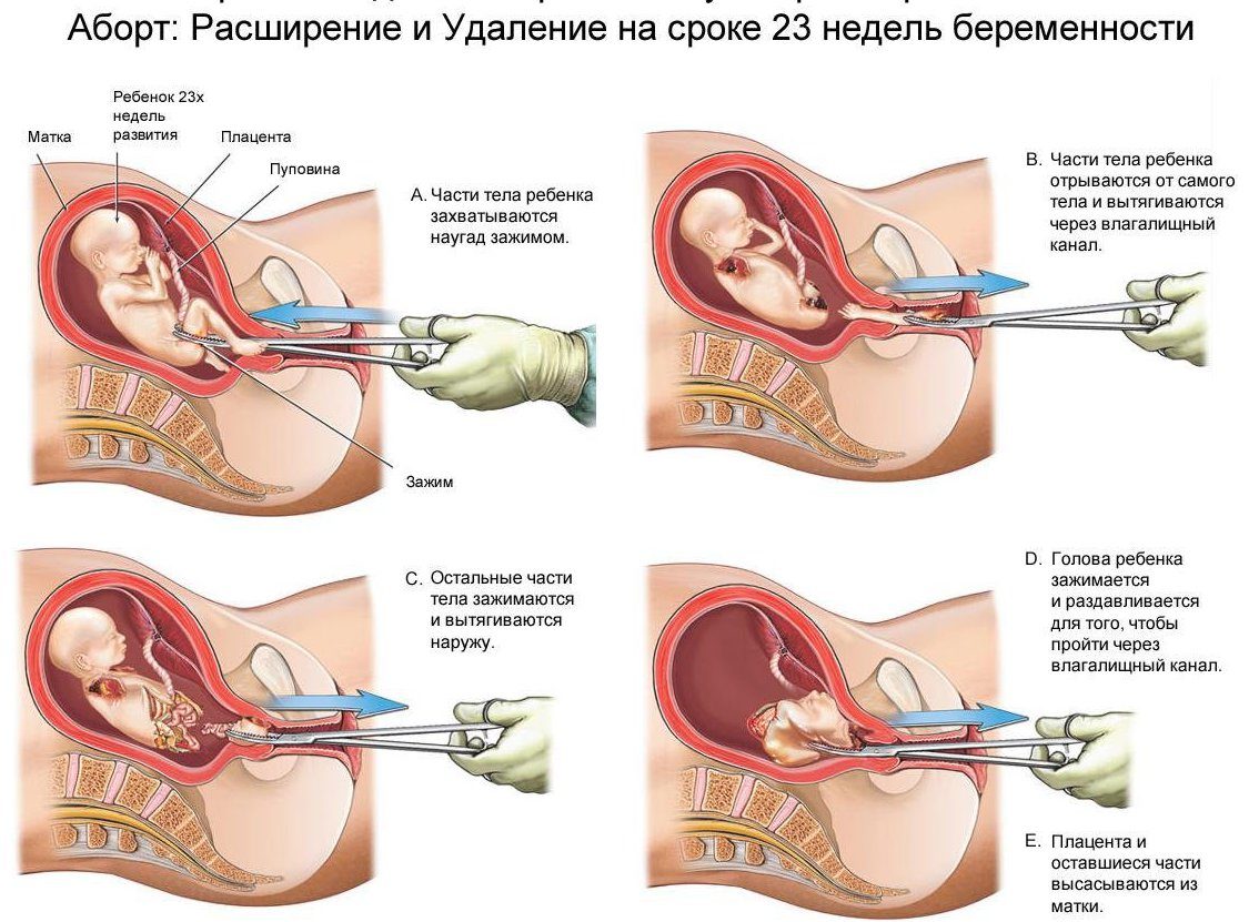 Расширение шейки матки