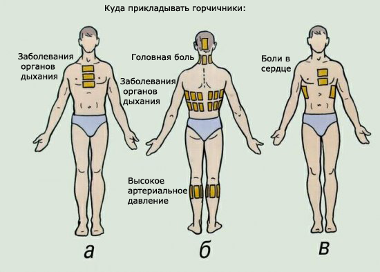 Места постановки пакетов с горчицей в зависимости от заболевания.