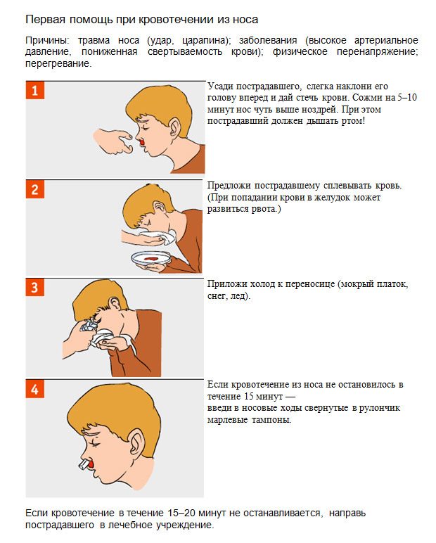 Оказание помощи при носовом кровотечении.