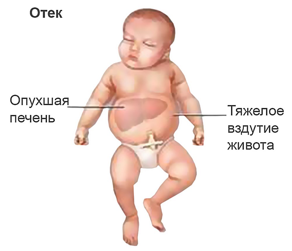 Резус-конфликт последствия для ребенка