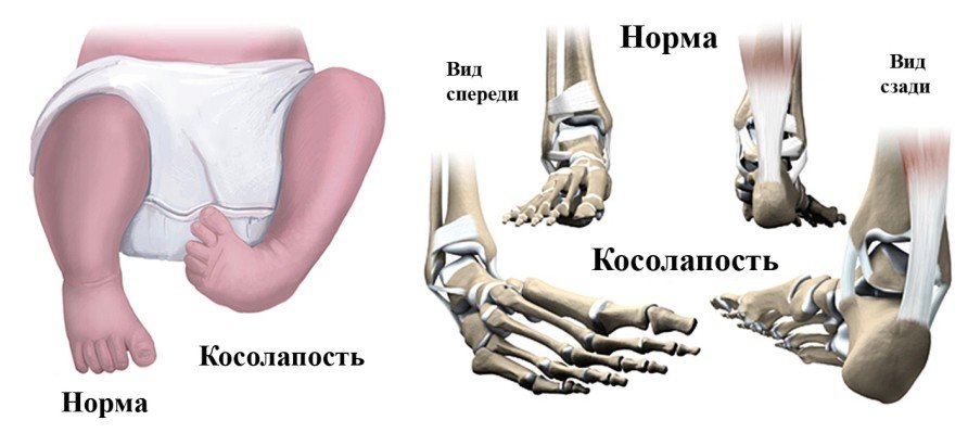 Косолапость означает деформацию стоп.