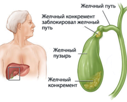 Лечение камней в желчном пузыре без операции. Можно ли удалить камни препаратами, народными средствами и гомеопатией?