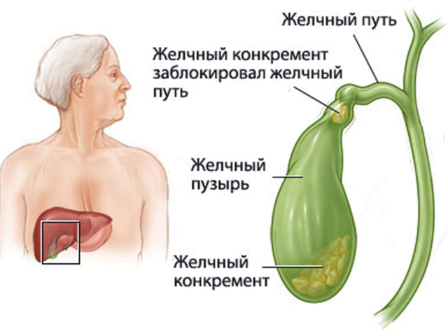 Лечение камней в желчном пузыре без операции. Можно ли удалить камни препаратами, народными средствами и гомеопатией?