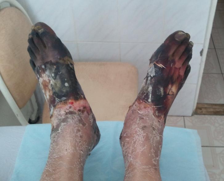 Обморожение ног четвертой степени.