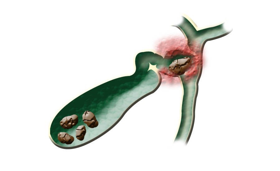 Закупорка камнями желчных протоков провоцирует приступ желчной колики.
