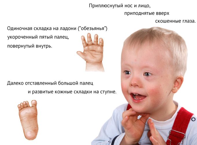 Лицо дауна