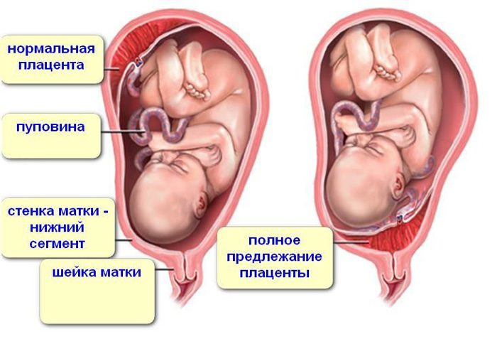Низкая плацентация при беременности