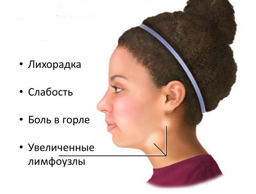 Симптомы мононуклеоза, вызванного вэб.