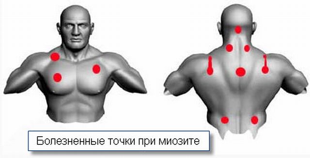 Миозит шейных мышц