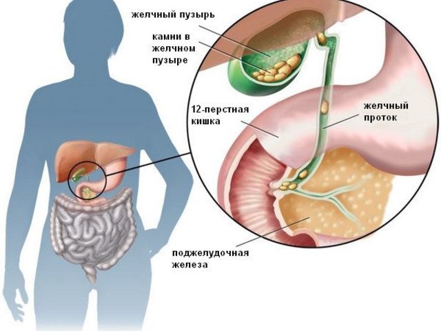 Камни в желчном пузыре: симптомы, признаки, причины. Питание и меню при камнях в желчном пузыре