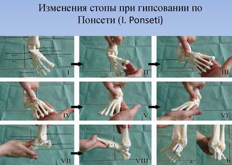 Изменение стопы при гипсовании методом понсети