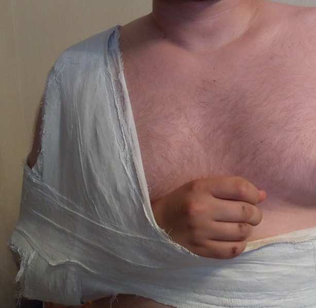 Гипсование поломанной ключицы.