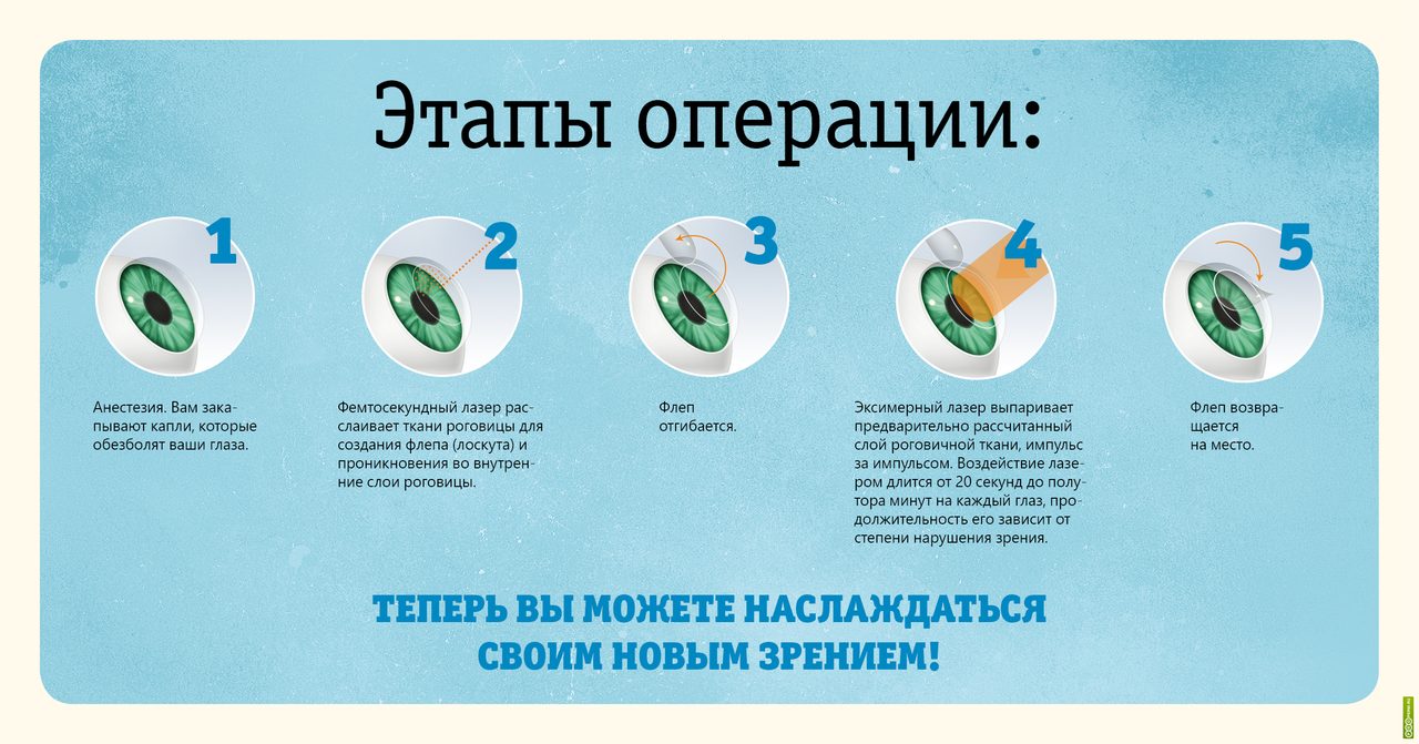 Этапы лазерной коррекции