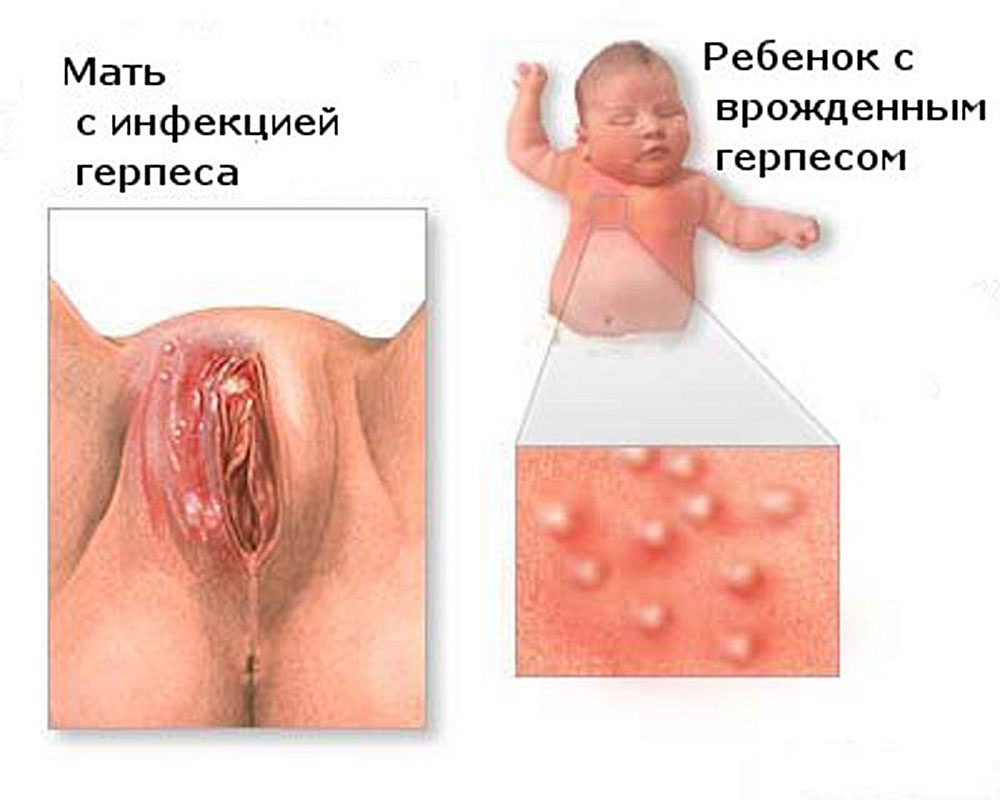 Генитальный герпес у новорожденных - это смертельная опасность.