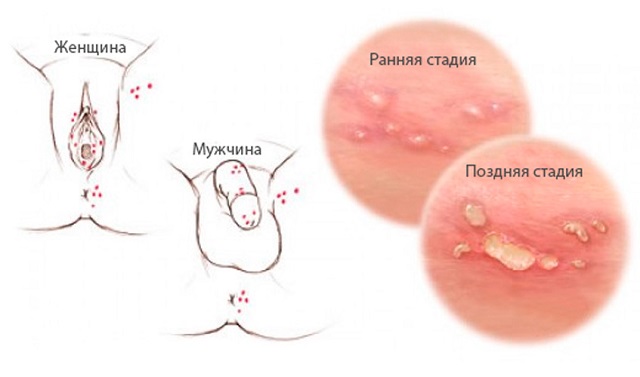 Герпес на половых органах у мужчин и женщин.
