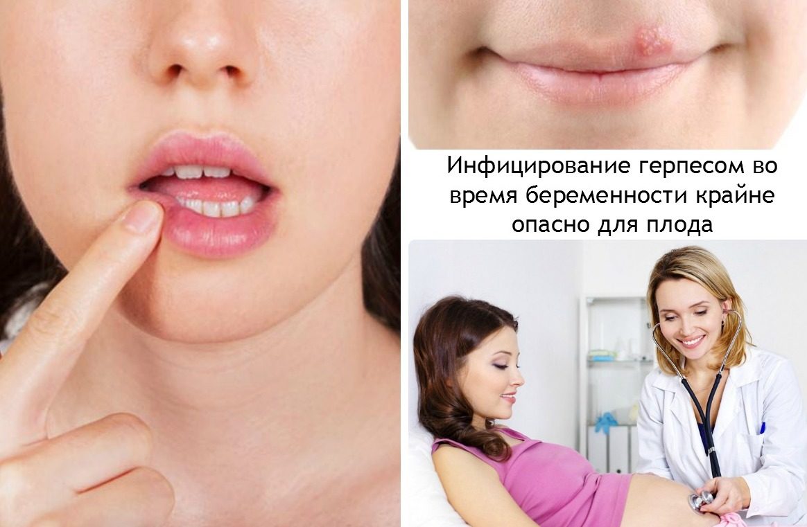 Первичное заражение герпесом во время беременности может представлять серьезную опасность для ребенка.