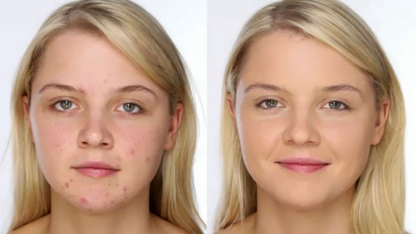 Березовый деготь уменьшит симптомы демодекоза