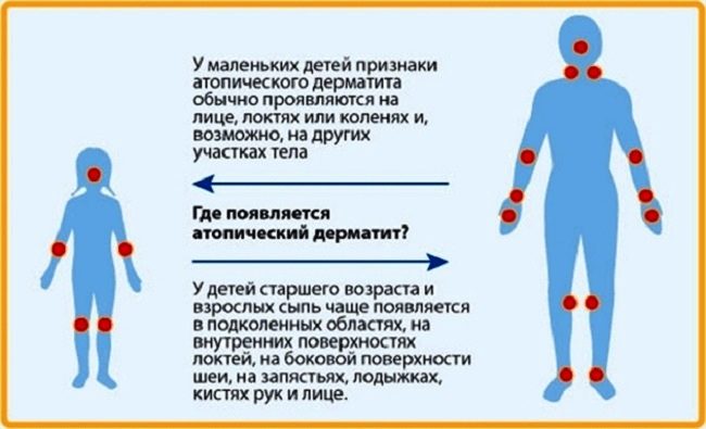 Где появляется атопический дерматит у детей?